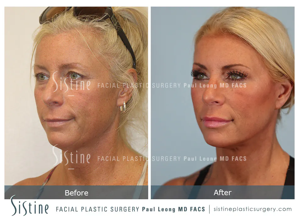 Facelift Before and After | Leong Facial Plastic Surgery