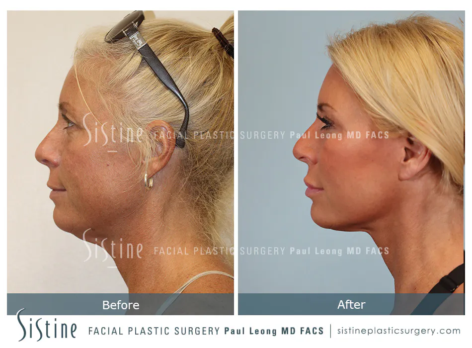 Facelift Before and After | Leong Facial Plastic Surgery