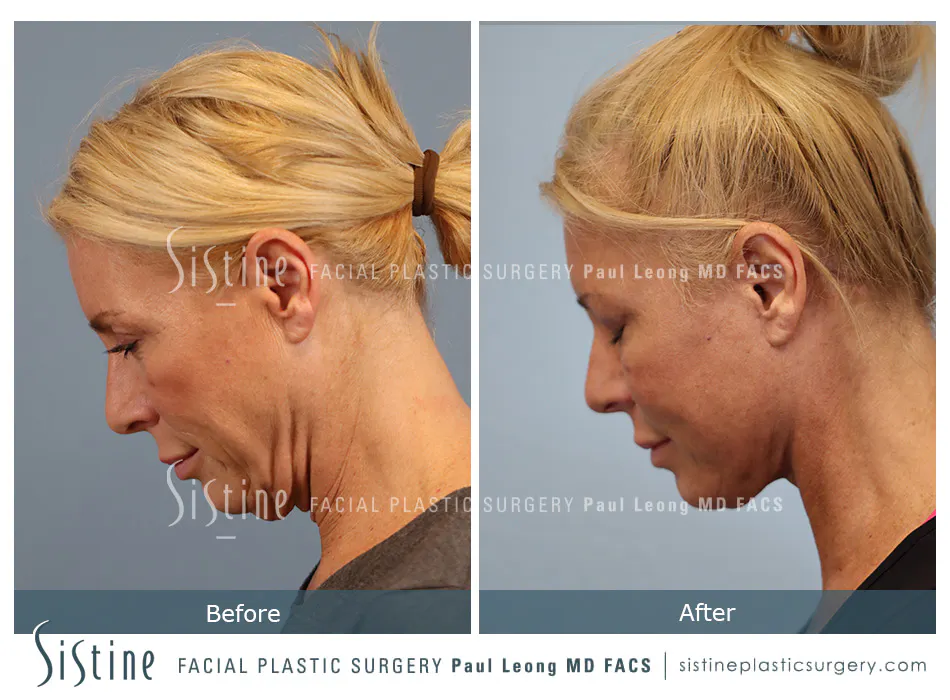 Facelift Before and After | Leong Facial Plastic Surgery