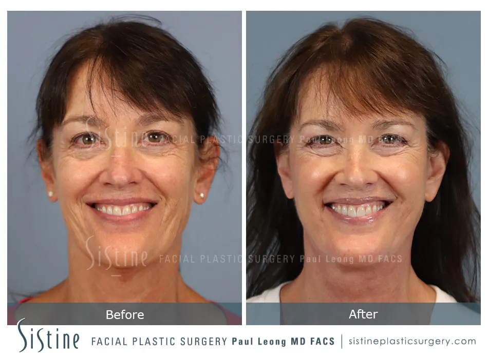 Facelift Before and After | Leong Facial Plastic Surgery