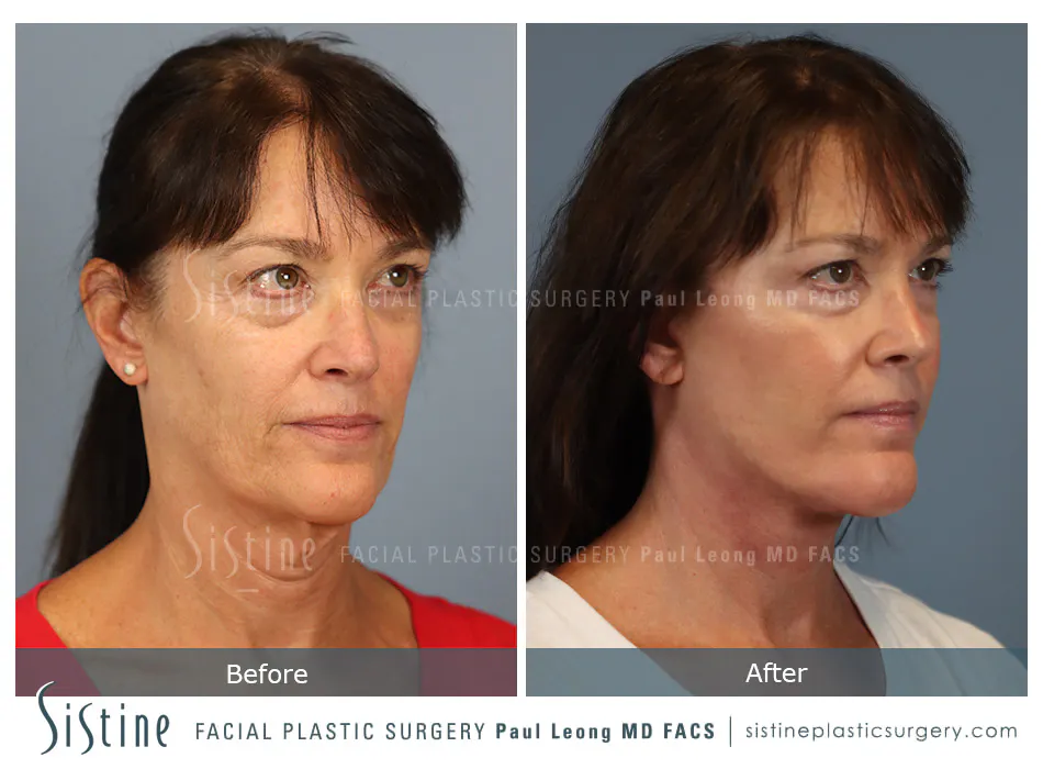 Facelift Before and After | Leong Facial Plastic Surgery