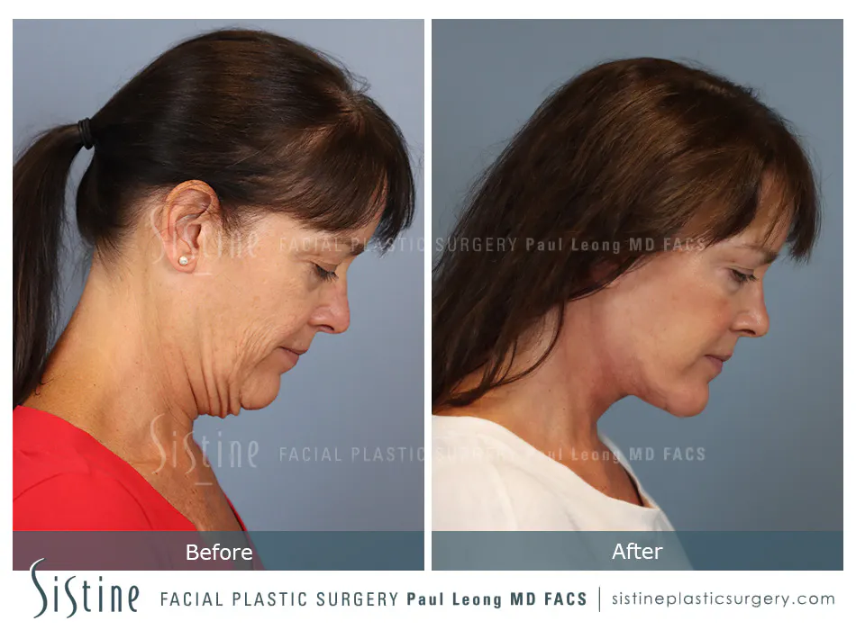 Facelift Before and After | Leong Facial Plastic Surgery