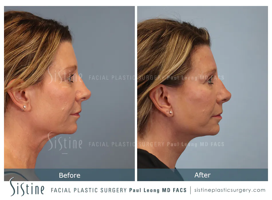 Facelift Before and After | Leong Facial Plastic Surgery