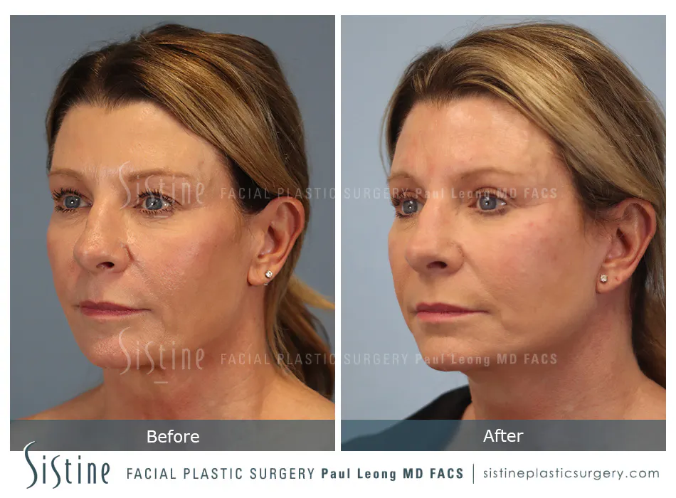 Facelift Before and After | Leong Facial Plastic Surgery