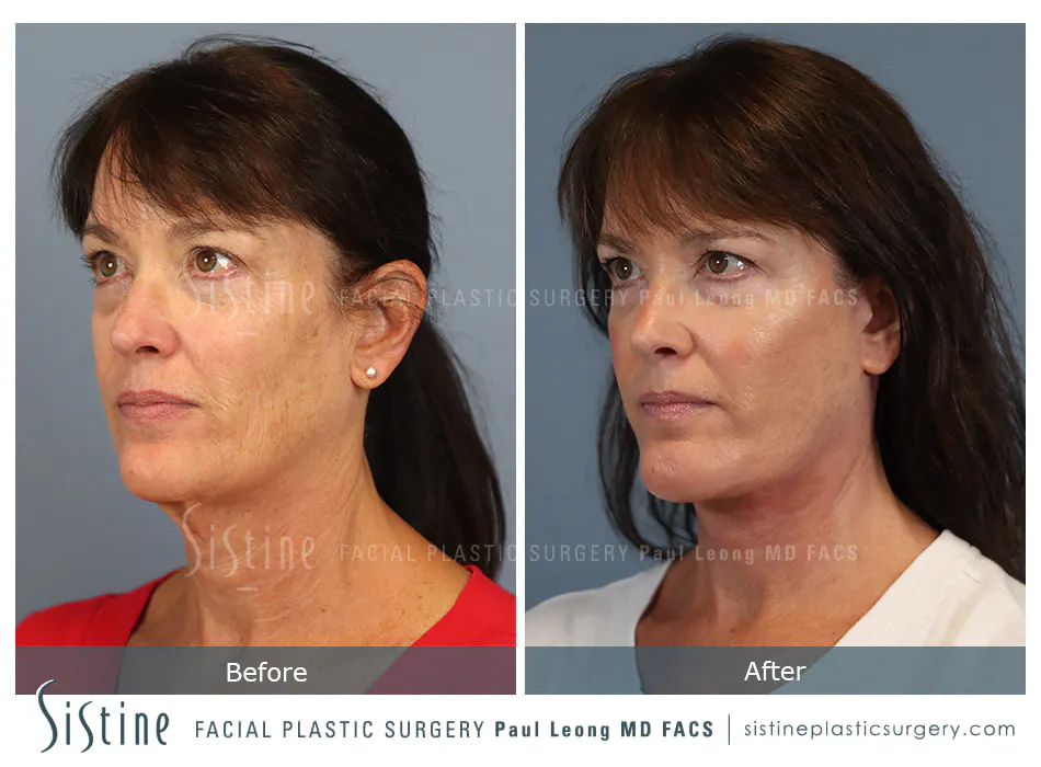 Facelift Before and After | Leong Facial Plastic Surgery