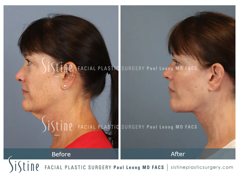 Facelift Before and After | Leong Facial Plastic Surgery