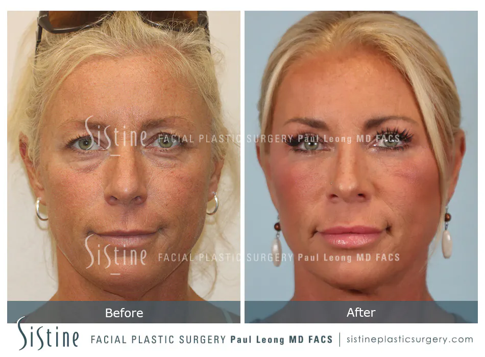 Facelift Before and After | Leong Facial Plastic Surgery