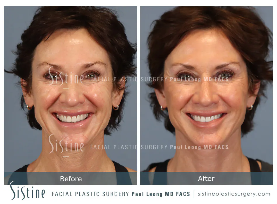 Facelift Before and After | Leong Facial Plastic Surgery