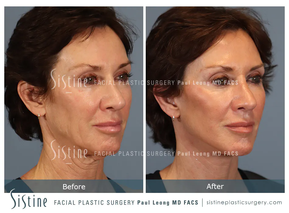 Facelift Before and After | Leong Facial Plastic Surgery