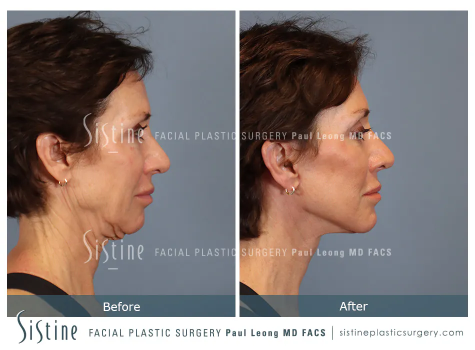 Facelift Before and After | Leong Facial Plastic Surgery