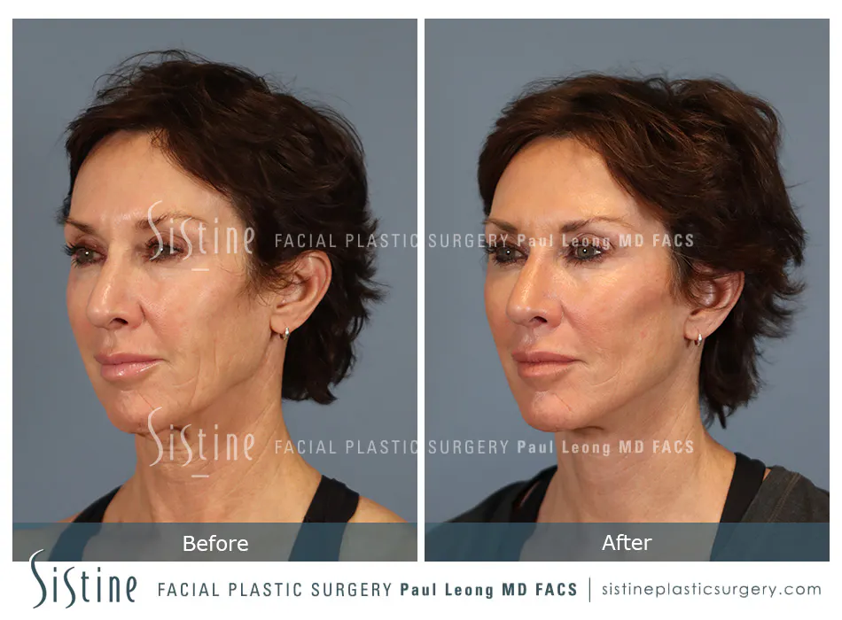 Facelift Before and After | Leong Facial Plastic Surgery