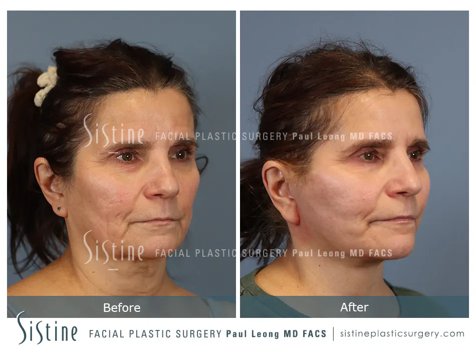 Facelift Before and After | Leong Facial Plastic Surgery