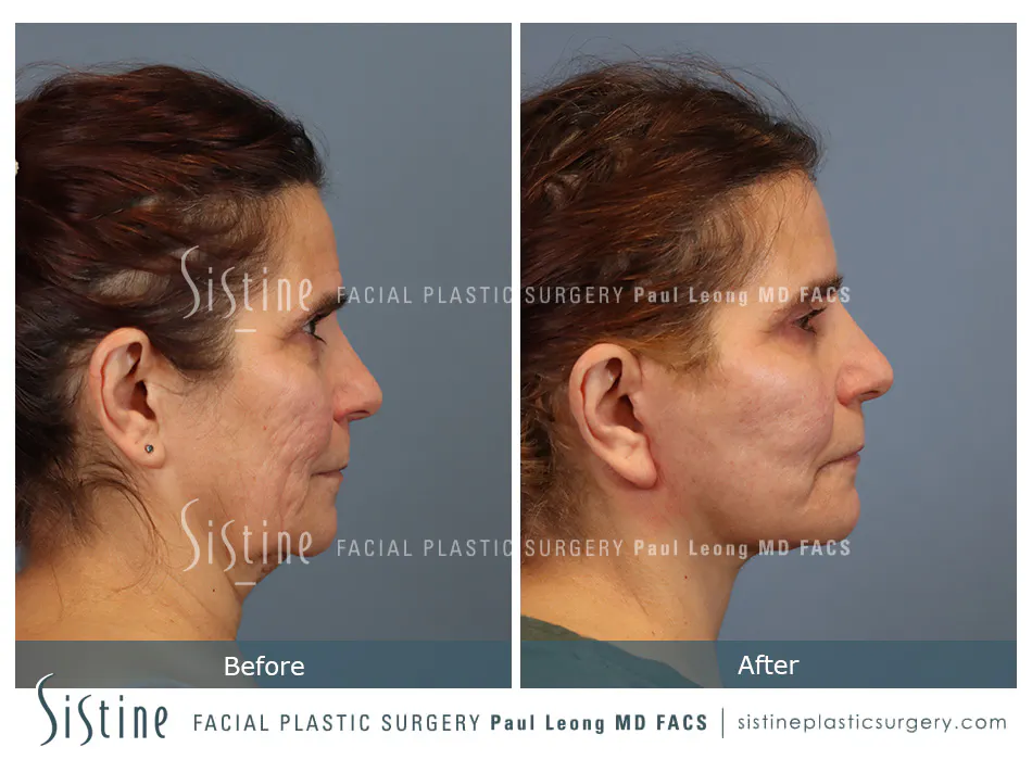 Facelift Before and After | Leong Facial Plastic Surgery