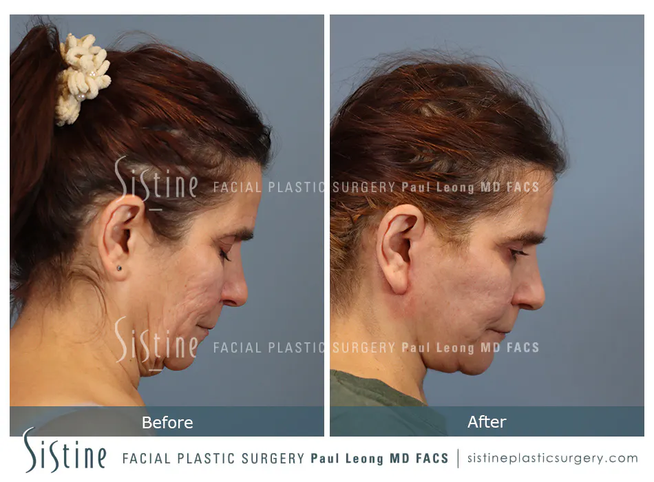 Facelift Before and After | Leong Facial Plastic Surgery
