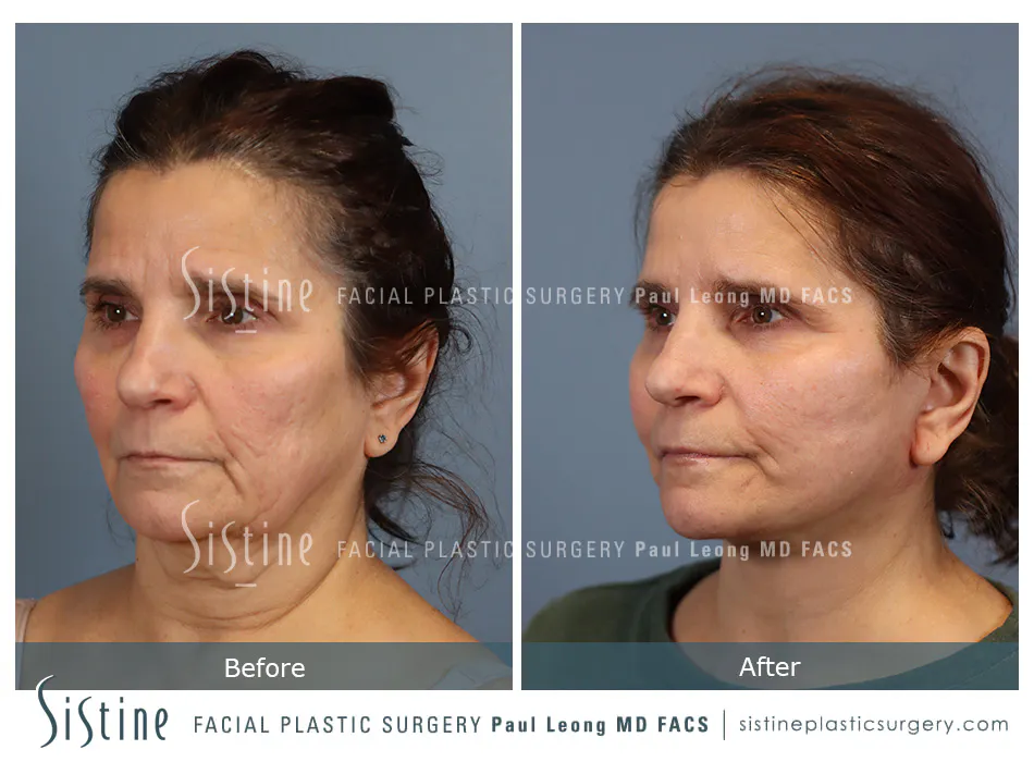 Facelift Before and After | Leong Facial Plastic Surgery