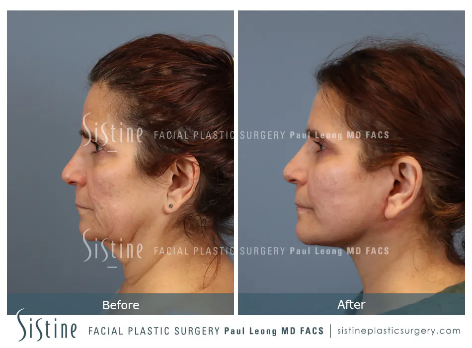 Facelift Before and After | Leong Facial Plastic Surgery