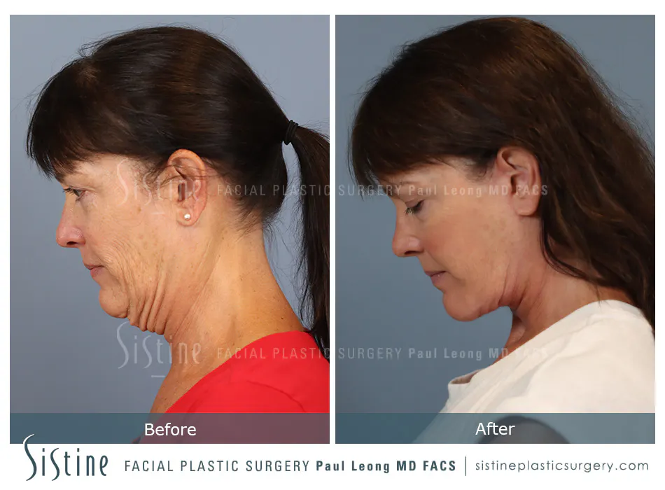 High SMAS Facelift in Pittsburgh - Preoperative Frontal View | Sistine Facial Plastic Surgery