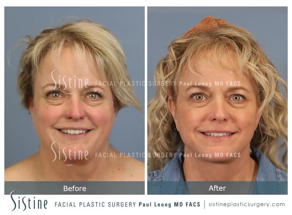 Facelift Before and After | Leong Facial Plastic Surgery