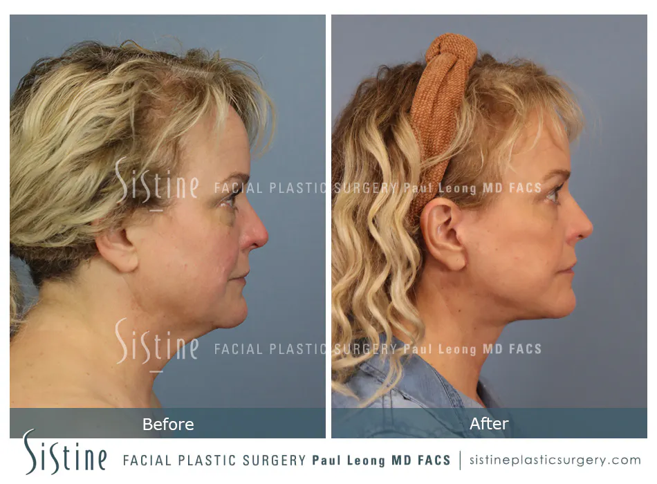 Facelift Before and After | Leong Facial Plastic Surgery