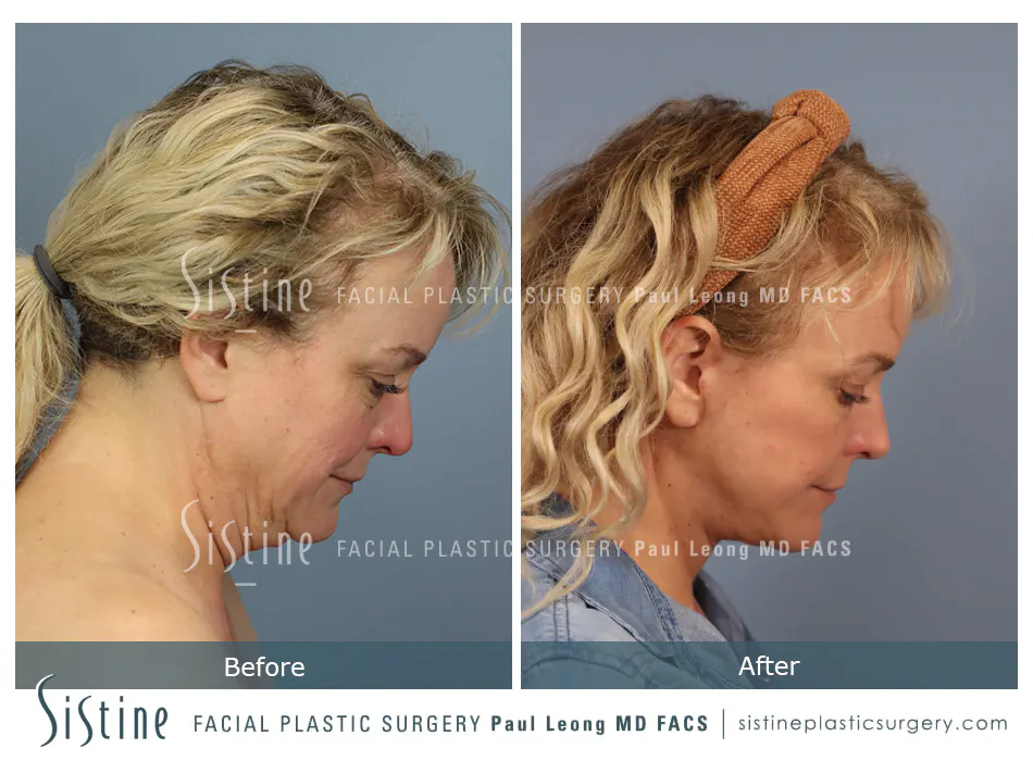 Facelift Before and After | Leong Facial Plastic Surgery