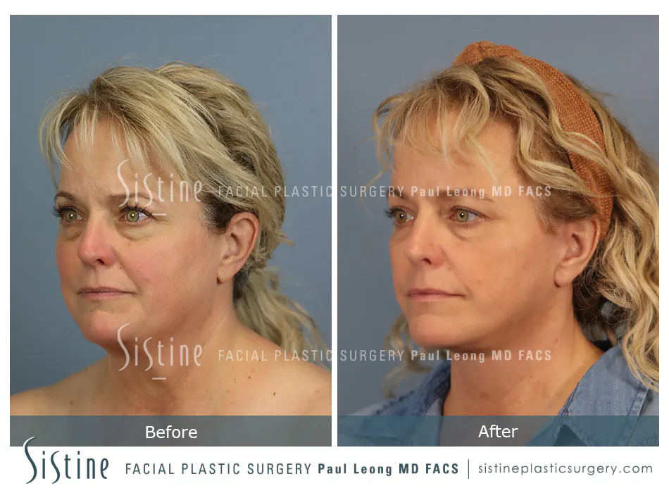 Facelift Before and After | Leong Facial Plastic Surgery