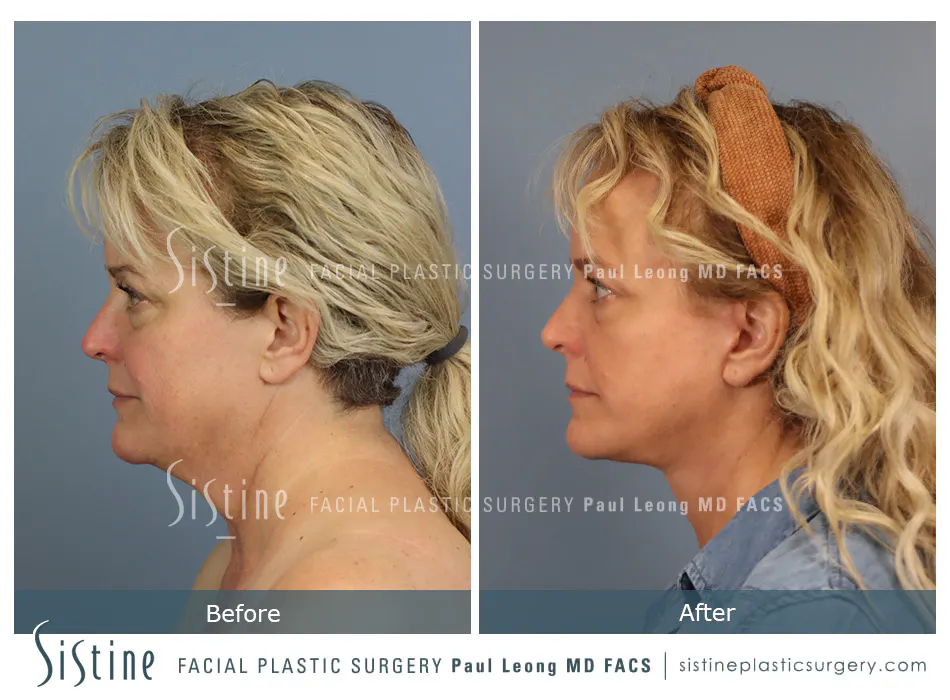 Facelift Before and After | Leong Facial Plastic Surgery