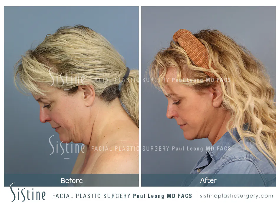 Facelift Before and After | Leong Facial Plastic Surgery