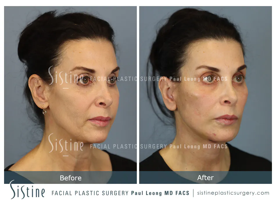 Facelift Before and After | Leong Facial Plastic Surgery