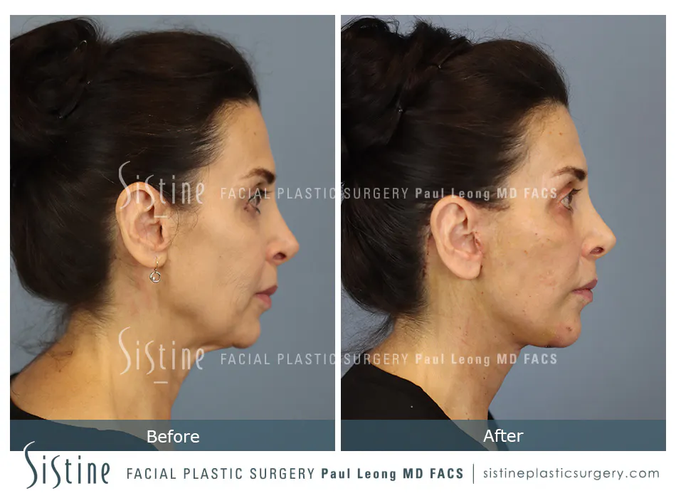 Facelift Before and After | Leong Facial Plastic Surgery