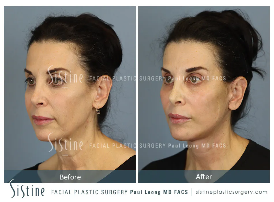 Facelift Before and After | Leong Facial Plastic Surgery