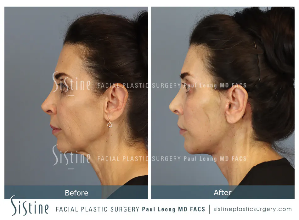 Facelift Before and After | Leong Facial Plastic Surgery