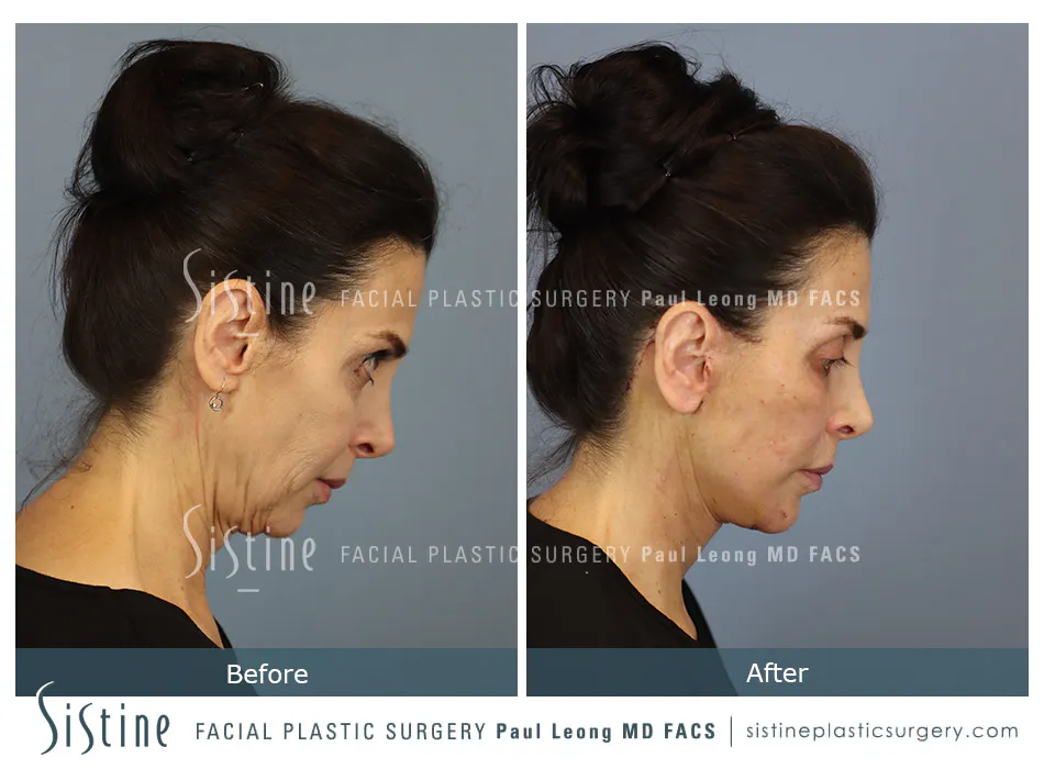 Facelift Before and After | Leong Facial Plastic Surgery