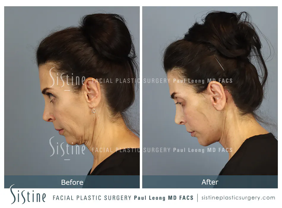 Facelift Before and After | Leong Facial Plastic Surgery