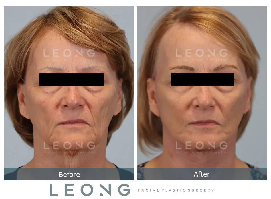 Facelift Before and After | Leong Facial Plastic Surgery