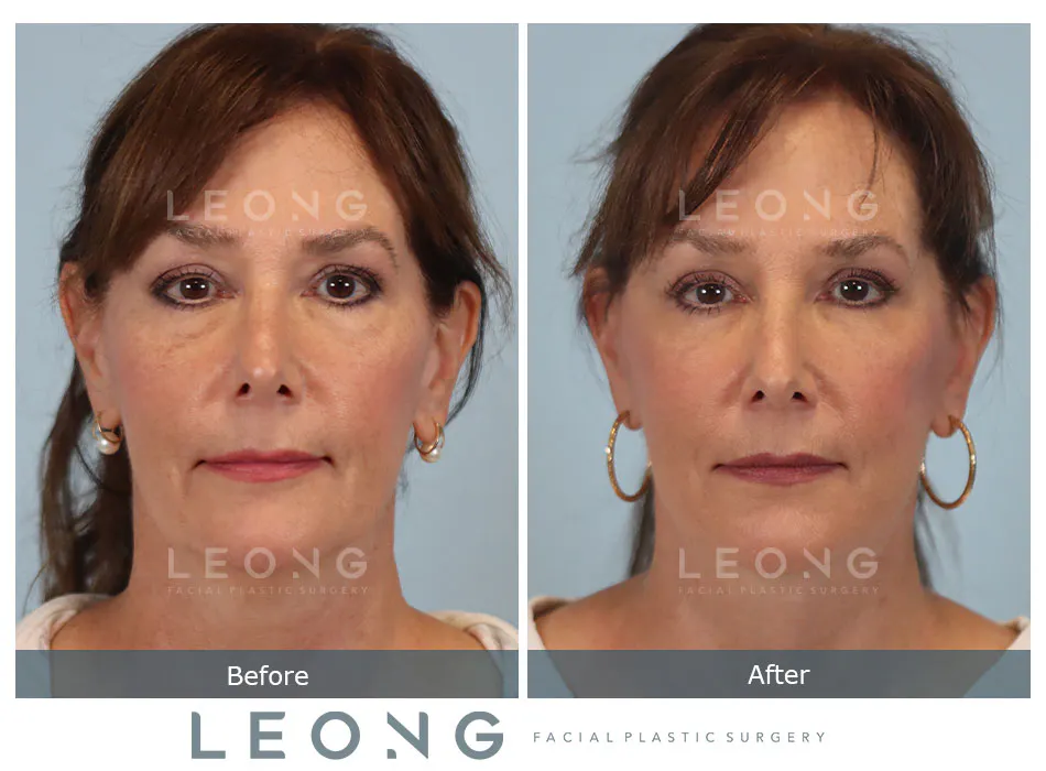 Facelift Before and After | Leong Facial Plastic Surgery