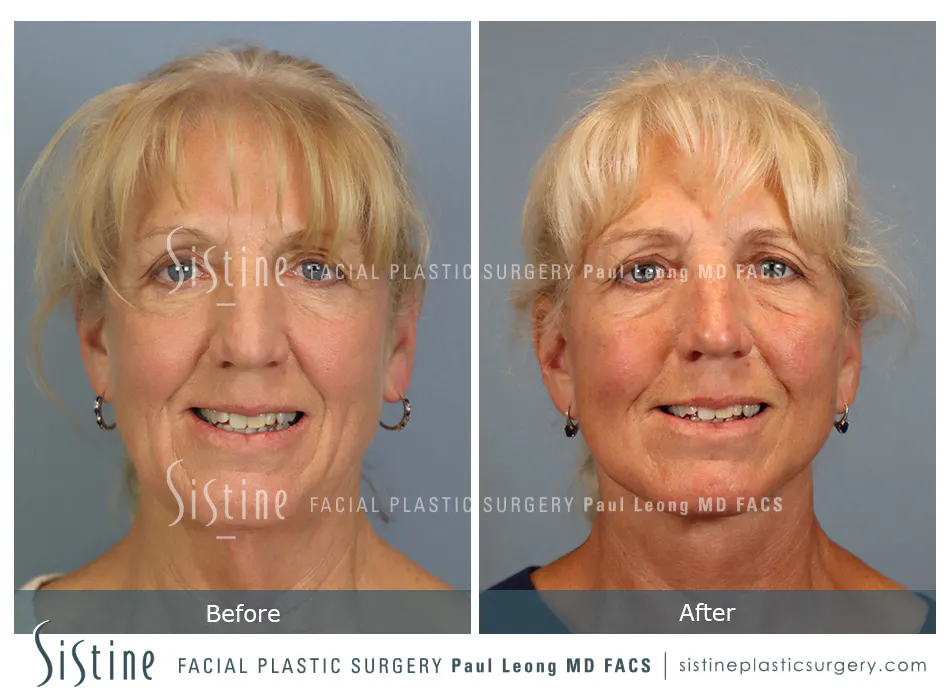 Facelift Before and After | Leong Facial Plastic Surgery