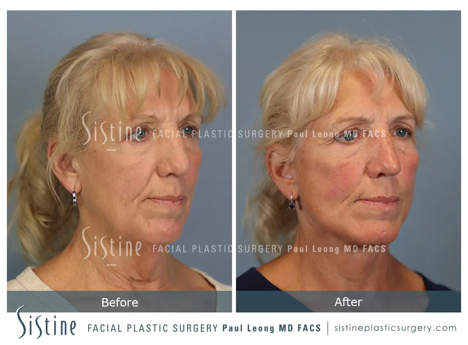 Facelift Before and After | Leong Facial Plastic Surgery