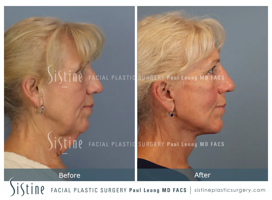 Facelift Before and After | Leong Facial Plastic Surgery