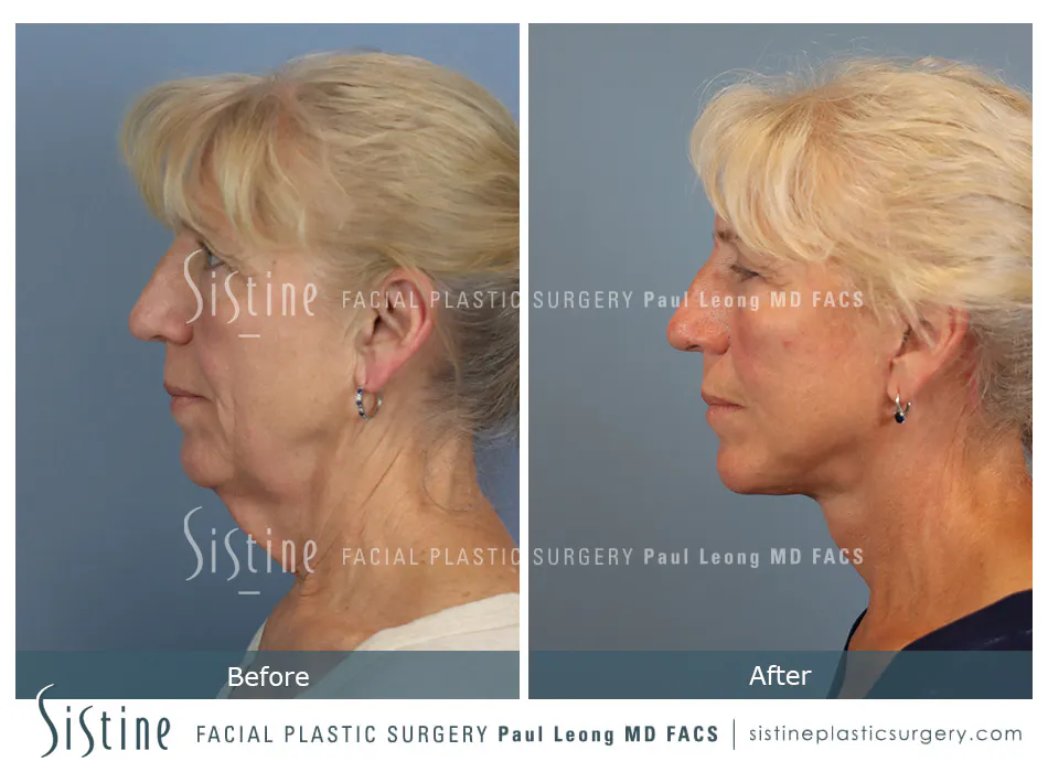 Facelift Before and After | Leong Facial Plastic Surgery