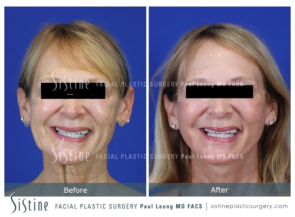Facelift Before and After | Leong Facial Plastic Surgery