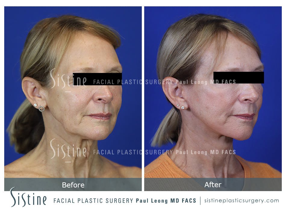 Facelift Before and After | Leong Facial Plastic Surgery