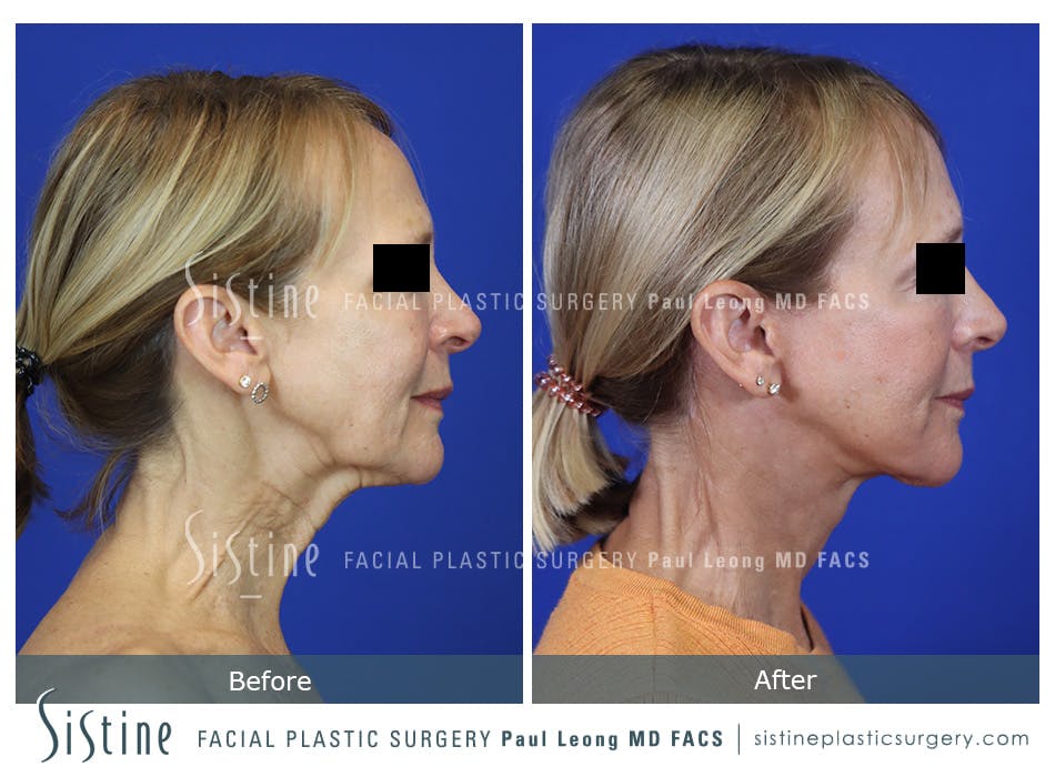 Facelift Before and After | Leong Facial Plastic Surgery