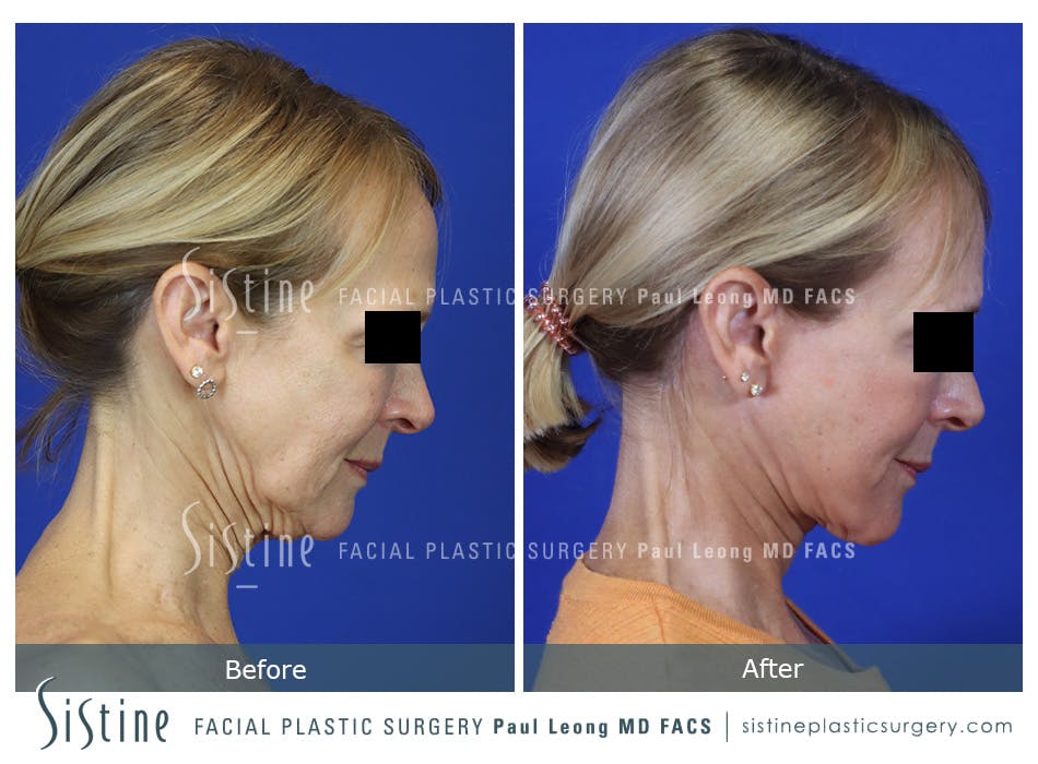 Facelift Before and After | Leong Facial Plastic Surgery