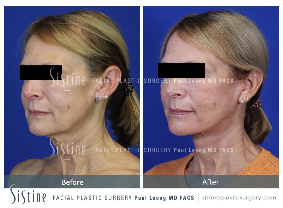 Facelift Before and After | Leong Facial Plastic Surgery