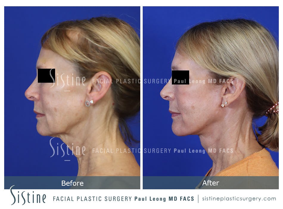 Facelift Before and After | Leong Facial Plastic Surgery
