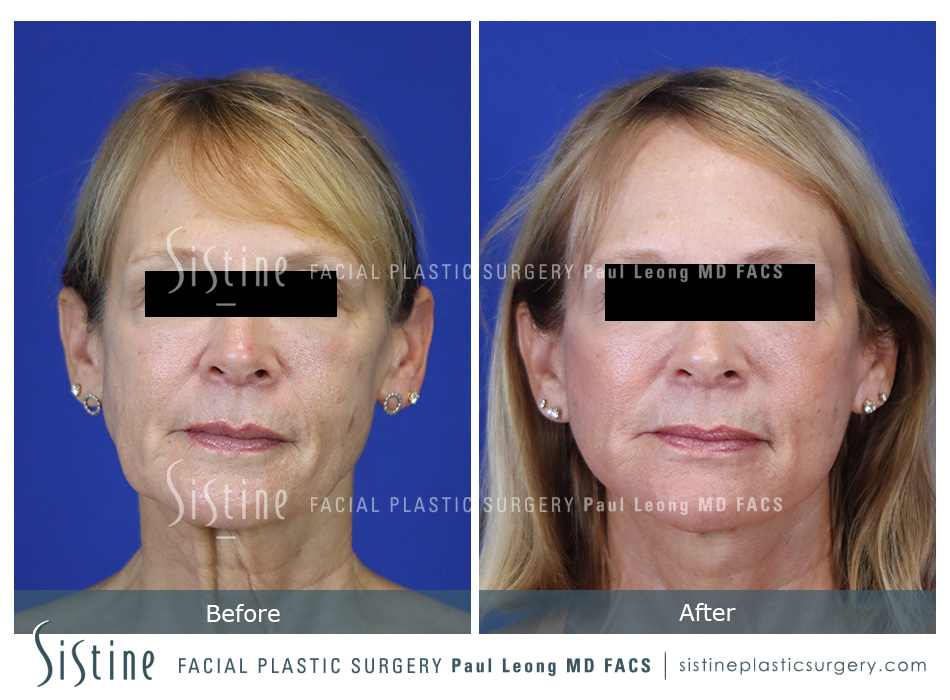 Facelift Before and After 16 | Leong Facial Plastic Surgery