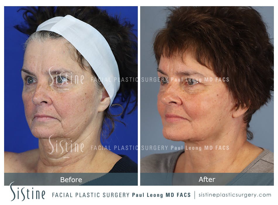 Facelift Before and After | Leong Facial Plastic Surgery