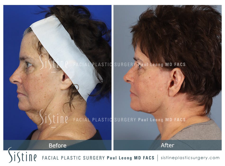 Facelift Before and After | Leong Facial Plastic Surgery