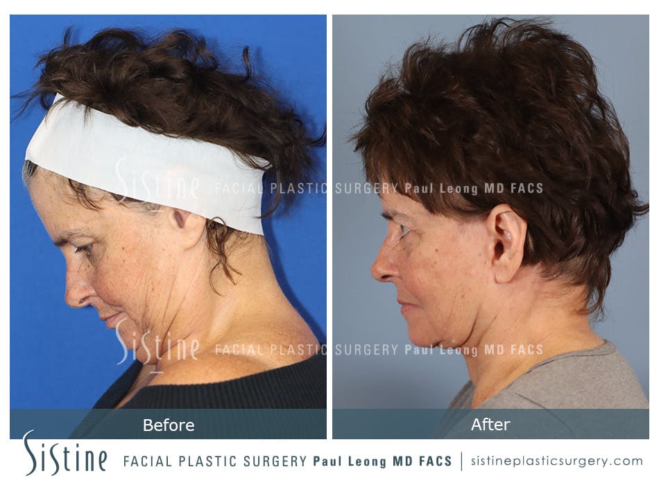 Facelift Before and After | Leong Facial Plastic Surgery