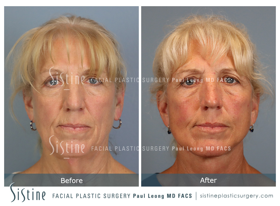 Facelift Before and After 01 | Leong Facial Plastic Surgery